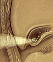 image of Biliary Lithotripsy illustration